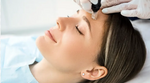 Skin Needling Full Face