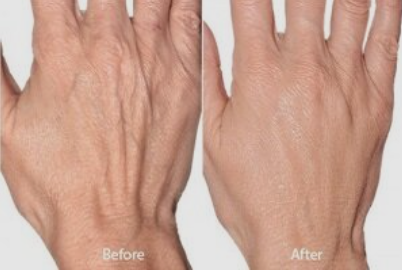 Skin Needling Back of Hands