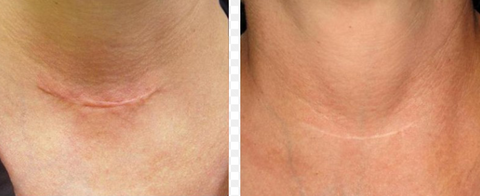 Skin Needling Neck